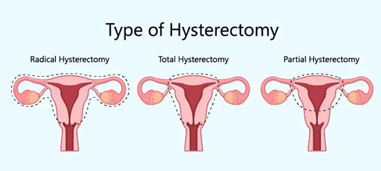 type of hysterectomy surgery in india